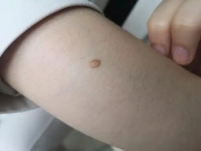 痣疣囊肿你会优先处理哪个