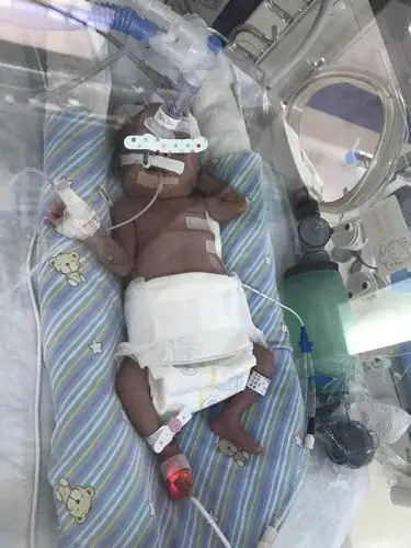 25周,本应该在妈妈肚子里被精心呵护的胎龄,却因为妈妈宫颈松弛,早早