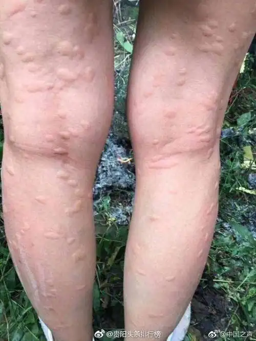 妹子摘橘子吃被蚊子盯得满腿是包 大腿成这样让人无比心疼