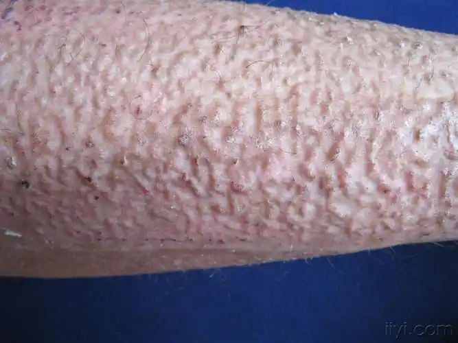 看图识病————皮肤淀粉样变