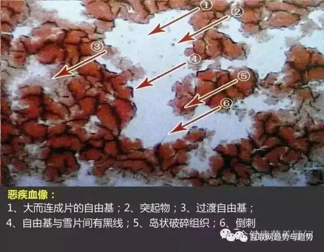 健康一滴血检测检测之干血对照图