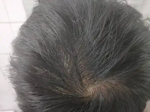 头顶这头发正常吗