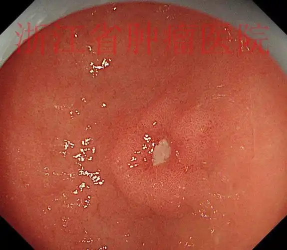 胃窦溃疡型早癌,您会怎么处理?