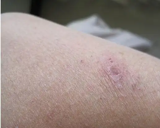 男性疥疮图片51