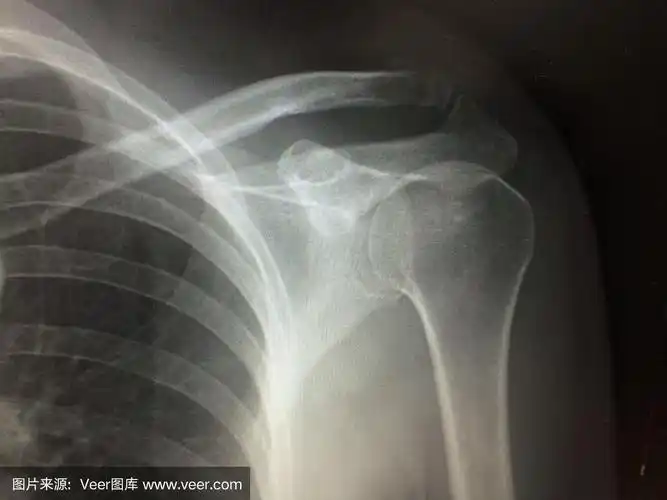 x线显示锁骨远端骨折
