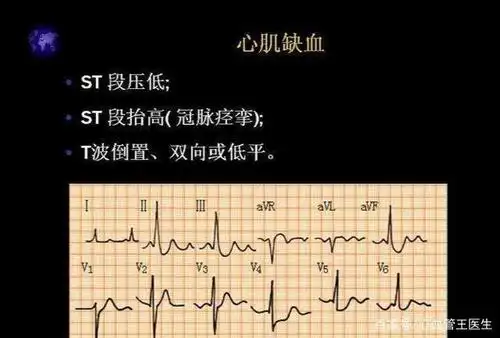 做完心电图提示心肌缺血就是心肌缺血医生辟谣不能
