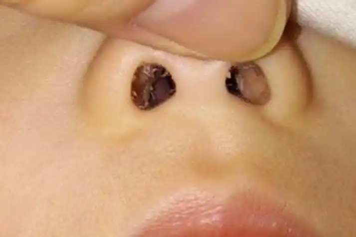 正常鼻孔内部高清图片_有来医生