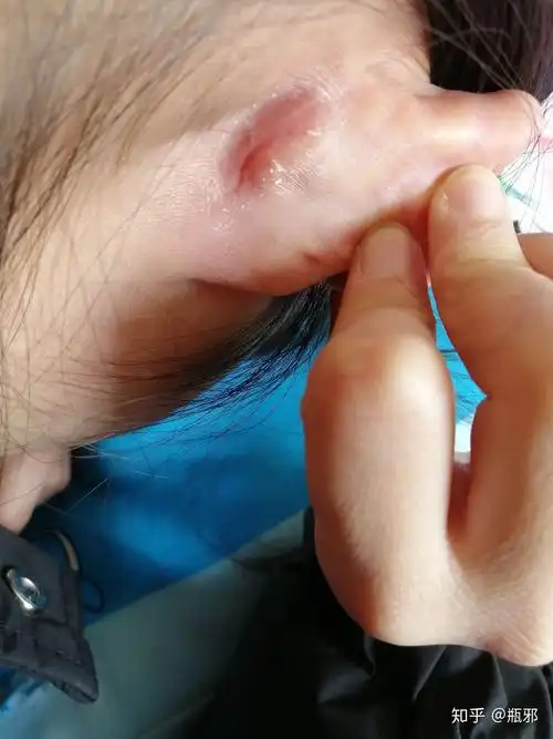 耳朵后面掉干皮 已经几年了 一直抠一直长 有时会有水 请问是什么问题
