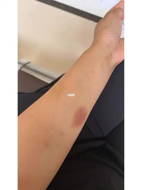 痔疮手术第7天终于回家了