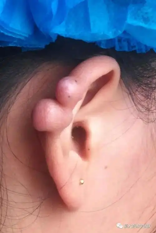 打耳洞后保持清洁干燥,一旦有增生倾向,需到正规医疗机构就诊.