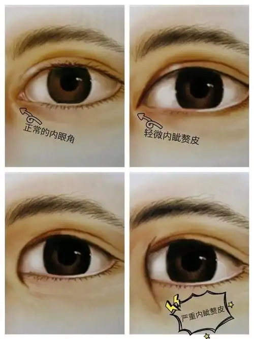 内眦赘皮 内眦赘皮就是上下眼睑之间的纵行皱皮,内眦赘皮会使眼帘变