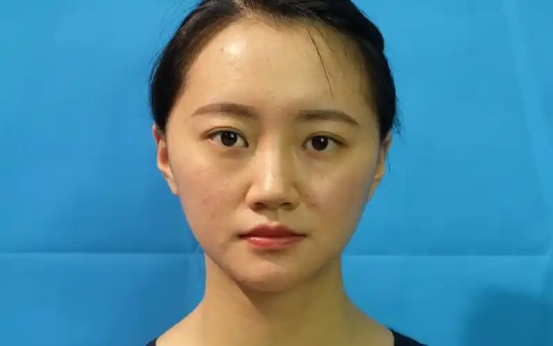 我脸凹陷得比较严重,第一张图那样,眼睛下头那里和脸_圈子-新氧美容