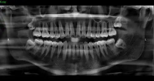 美亚尊影plus口腔cbctfov15105cm