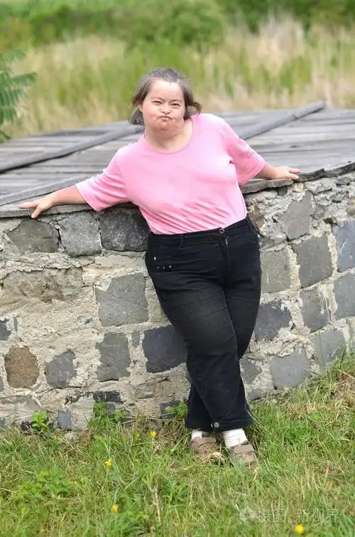 唐氏综合征的女人