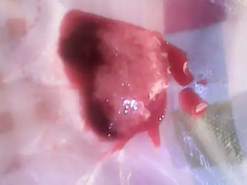 早孕药流排出的孕囊形状图片