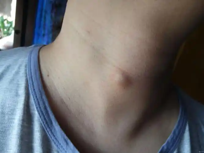 脖子长了个瘤子
