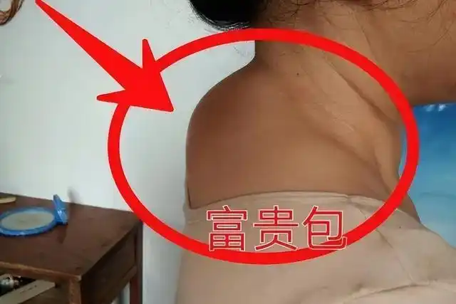 导语:从医学角度来看,富贵包其实是由颈椎管狭窄症引起的,而不是单纯