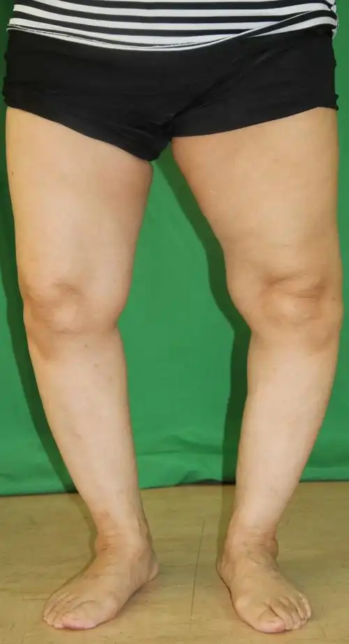 膝关节骨性关节炎,膝内翻,怎么治疗?