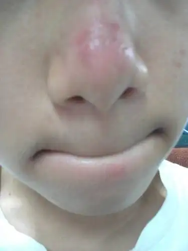 两年了,鼻子不会好,会肿起来,然后中间会有小洞,不会好,每次红红肿肿