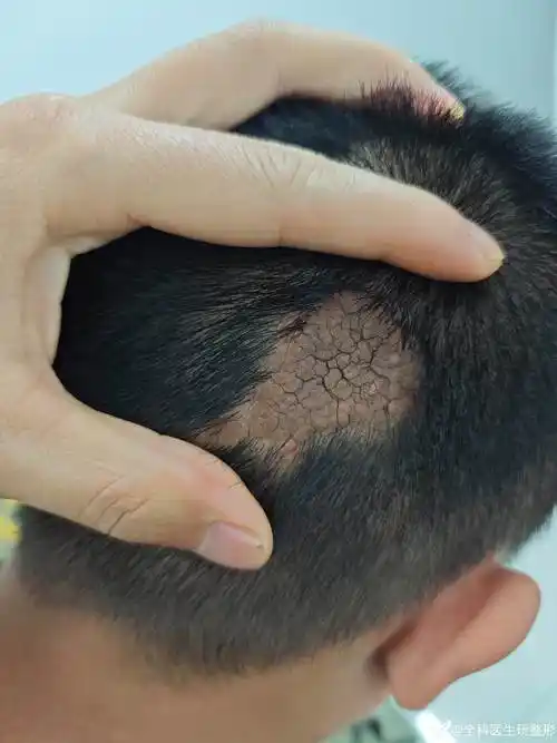 皮脂腺痣求手术方式