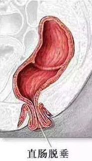脱肛患者如何自我调理