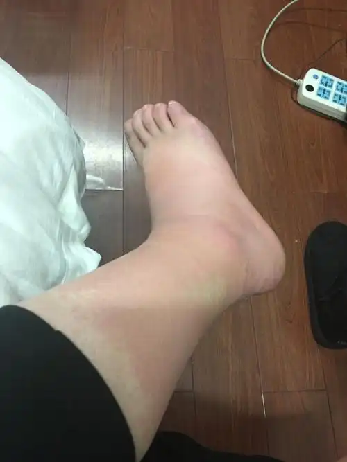 脚踝红肿疼 ,特别肿的地方出水泡了 怎么回事