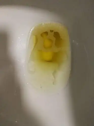 早晨泡沫尿是肾病吗?