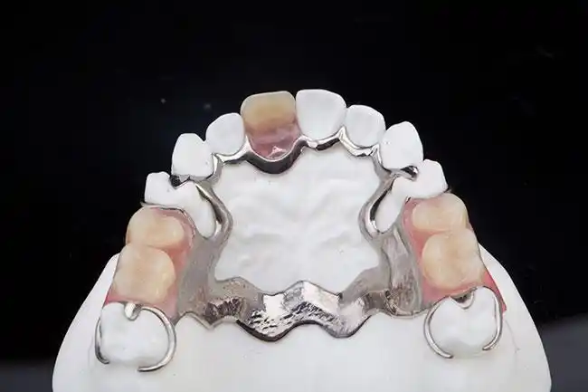 活动支架系列-纯钛支架 - 北京圣爱吉友和义齿制作有限公司