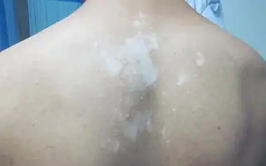 后背长白斑点图片