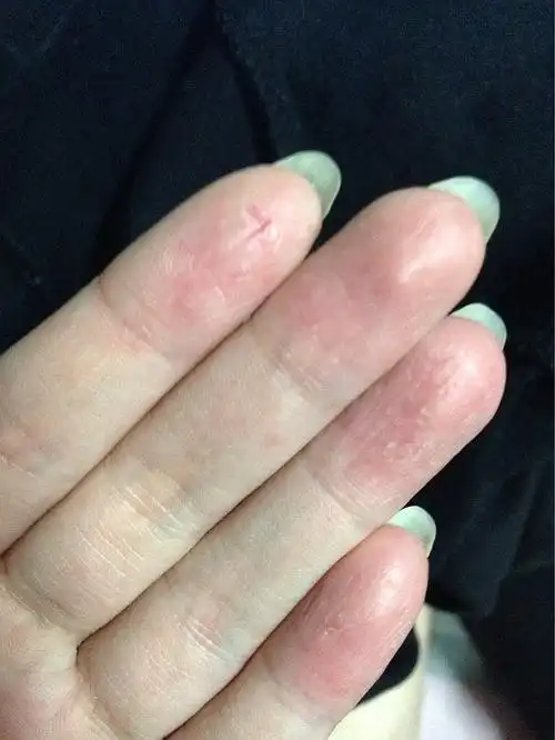 求问~~ 这个样子是得了手藓嘛?