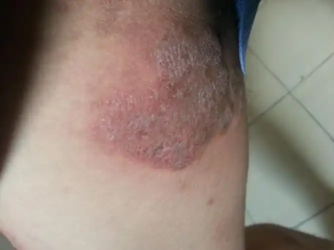 请问我大腿内侧生的这些是什么?