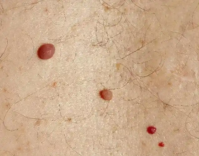 长在身上的「朱砂痣」