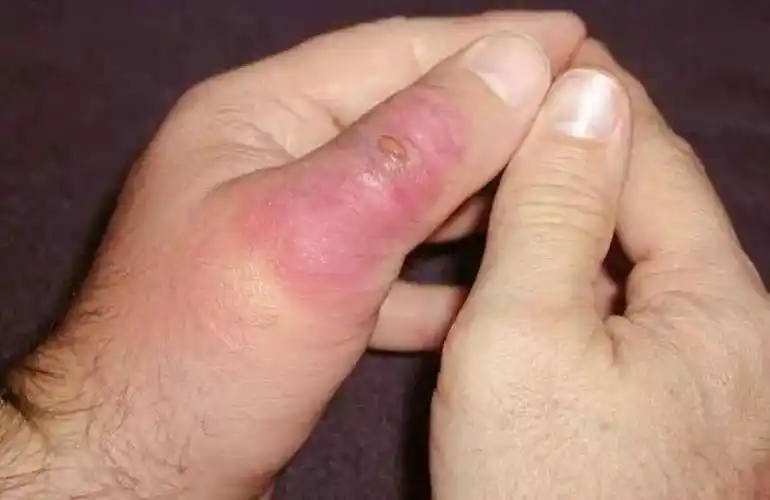 澳洲毒物"漏斗网蜘蛛"被咬一口,10分钟之内人将死亡!