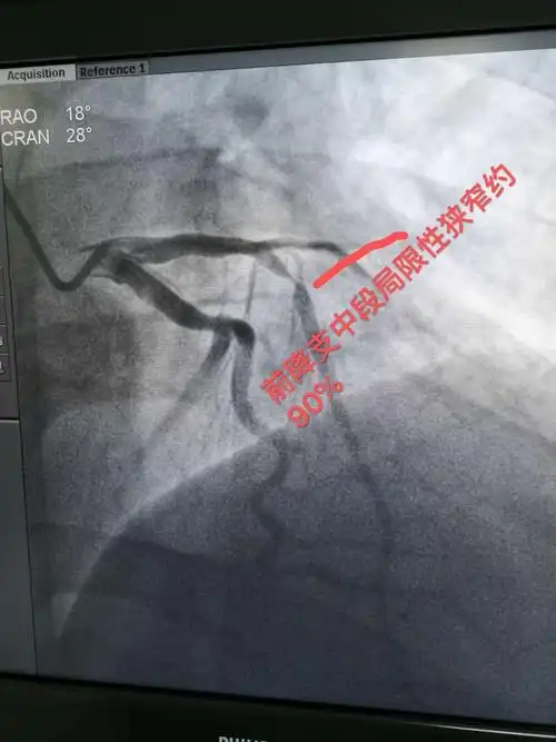 冠状动脉造影示前降支中段局限性狭窄约90%