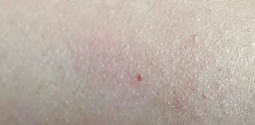 皮肤出现真尖大小的血点是咋回事