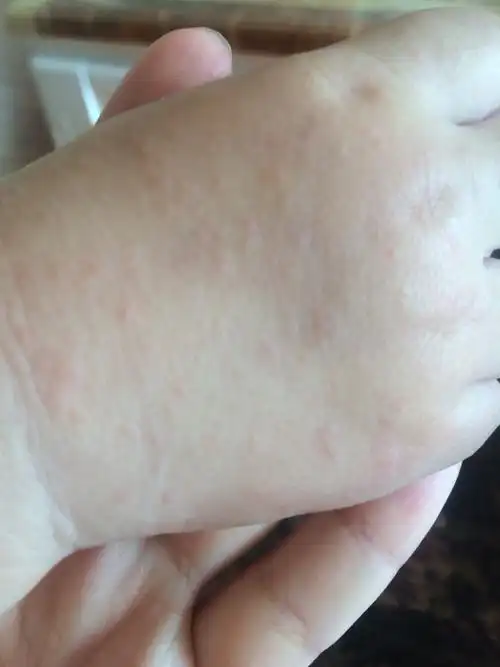 宝宝手上长了好多这种疙瘩,是怎么回事呢?