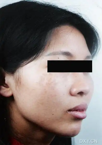 夏天的相册-褐青色痣样图