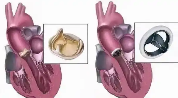 听医生怎么说_心脏_瓣膜_检查