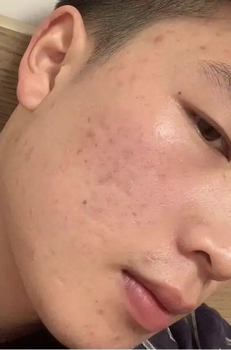 男生如何养成一张干净的脸毛孔粗大痘痘反复黑头问题的解决方法男士