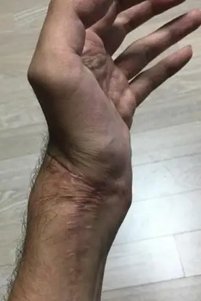 韩国男星截肢星途路断 怒曝"左手坏死惨状"