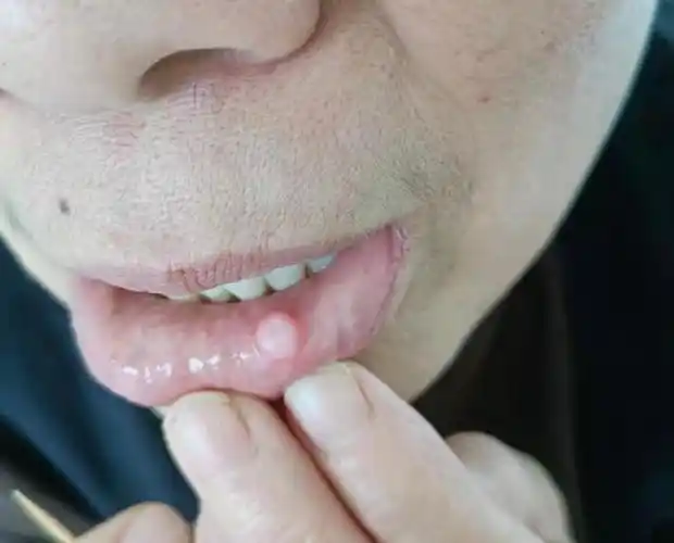 黏液腺囊肿为口腔黏膜小唾液腺导管阻塞后分泌液潴留而形成的浅表囊肿