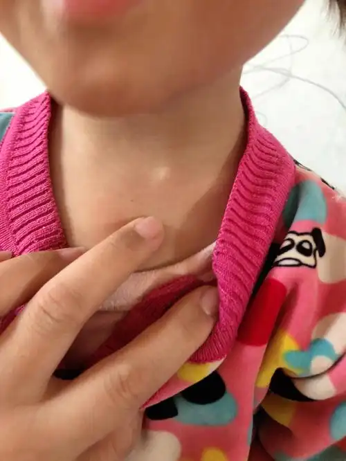 宝宝一边锁骨突出了一点,大家知道这是怎么了吗?