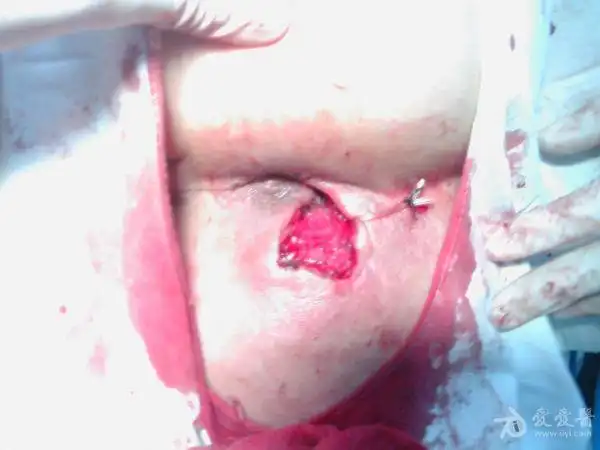 一例复杂性肛瘘的手术