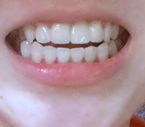 门牙做了全瓷牙但有人劝我做种植牙 我佛了