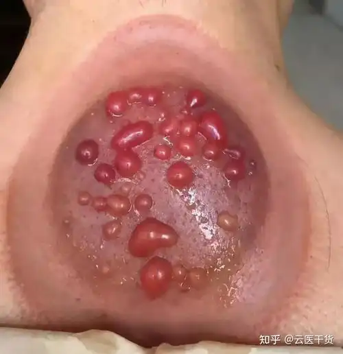 为什么拔罐后会起"水泡"或"鲜红"等不同罐印,一文讲明白 - 知乎