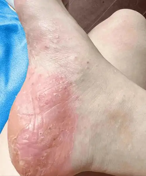 见效快成本低,居家就能解决脚气的小妙招分享!_症状_伤口_皮肤