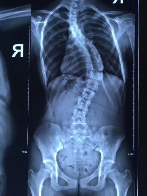 12岁女孩脊柱侧弯,"惠人 大兴"联合实施全脊柱矫形术