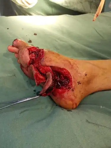 断足再植术后部分坏死,足底内皮瓣修复