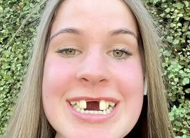 20岁女子出生后面部畸形 治疗后两门牙间距1.7厘米