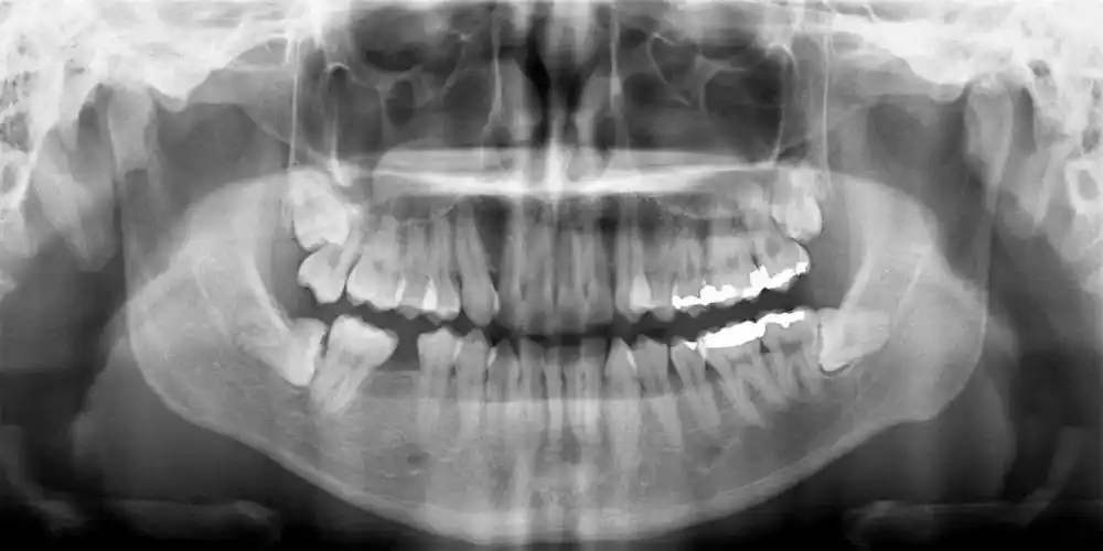 读懂口腔x线片你需要经历上百个病例影像资料的训练